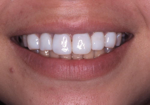 簡単に歯を白くする方法 歯を白くしたい！中学生でもできる自宅で歯を白くする方法とは？！