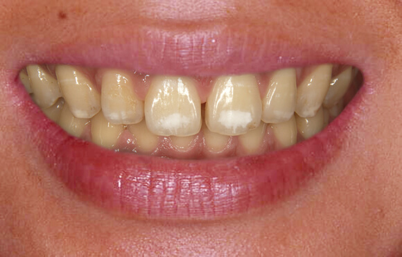 前歯の白いシミの治し方と費用