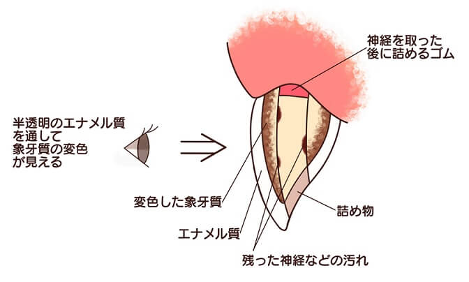 歯が変色する原因