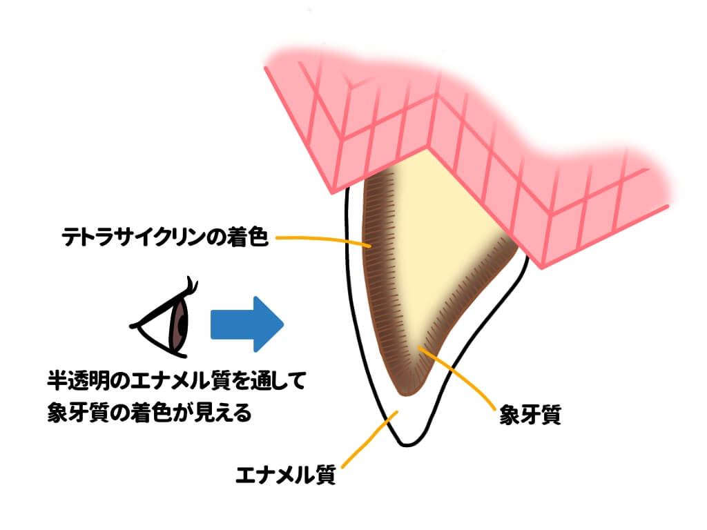 テトラサイクリン歯の図