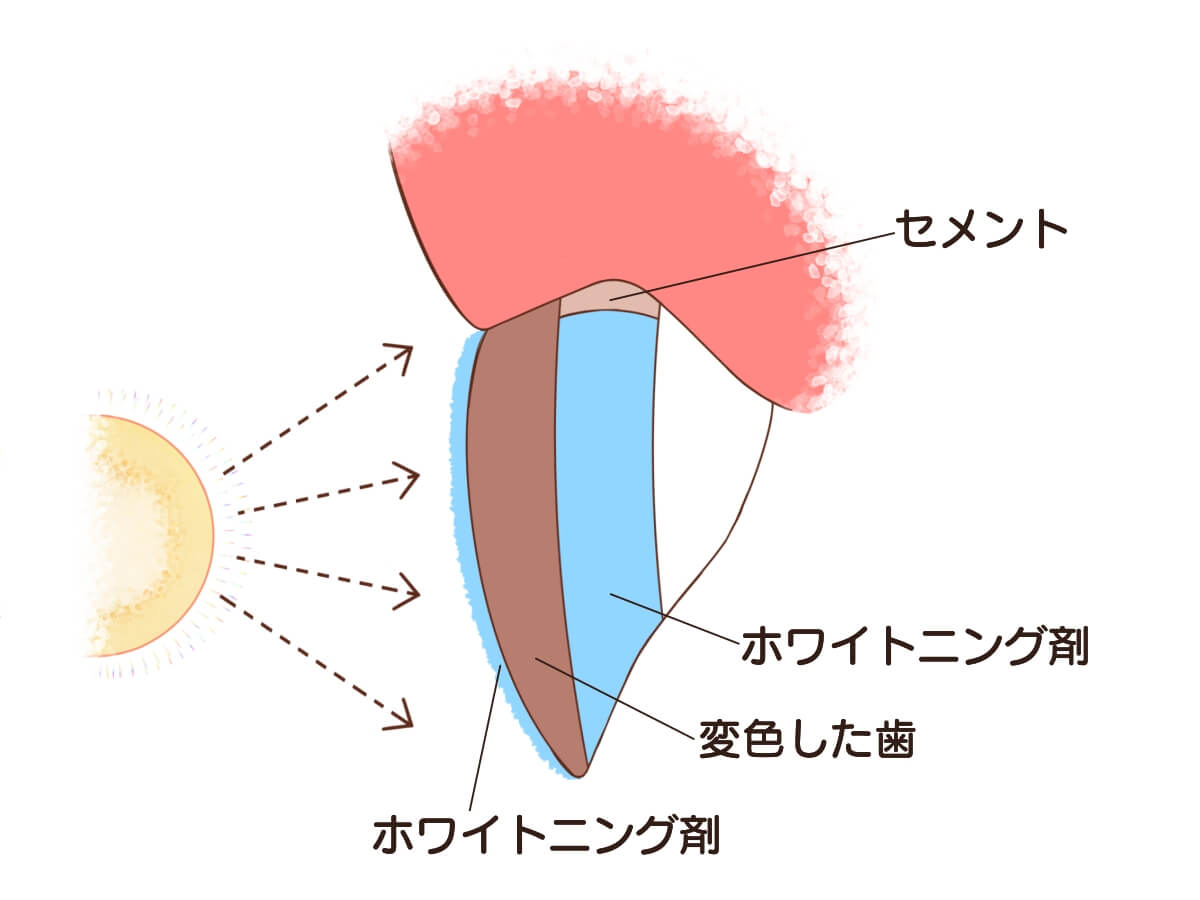 インターナルブリーチ