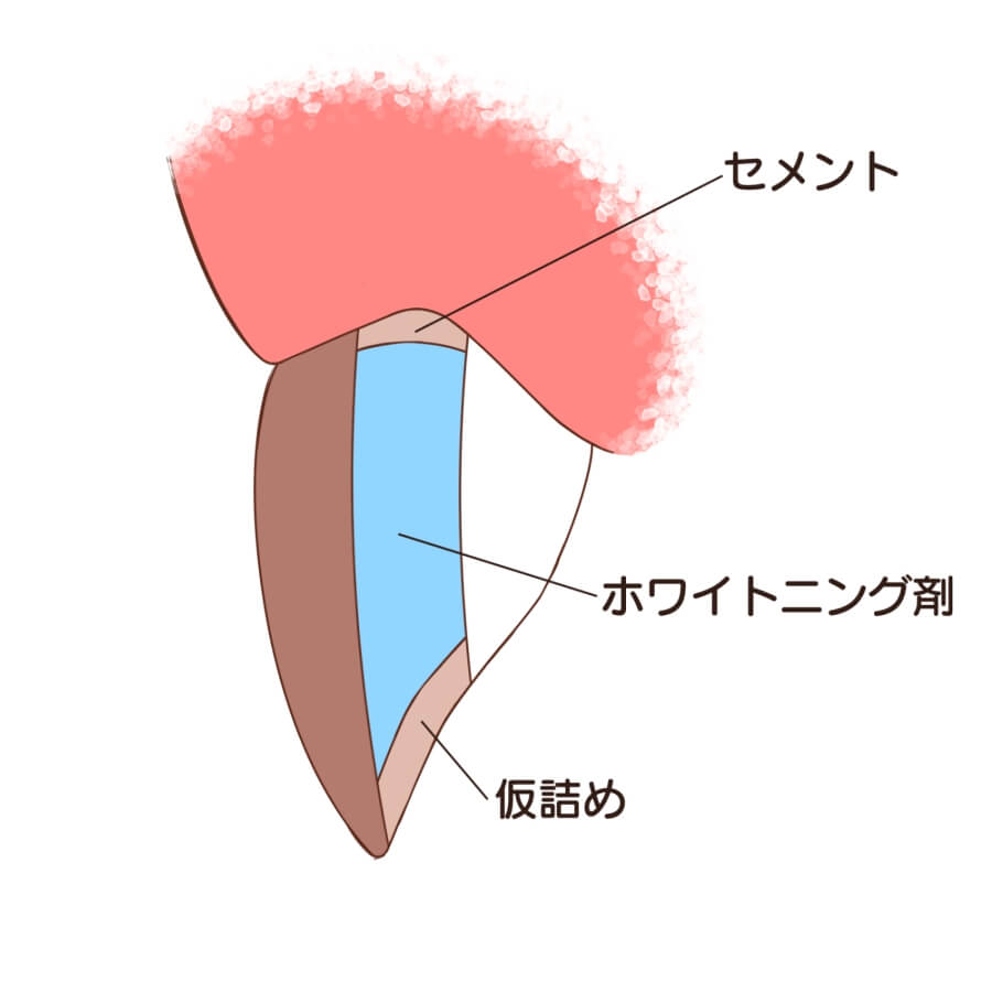 ウォーキングブリーチとは