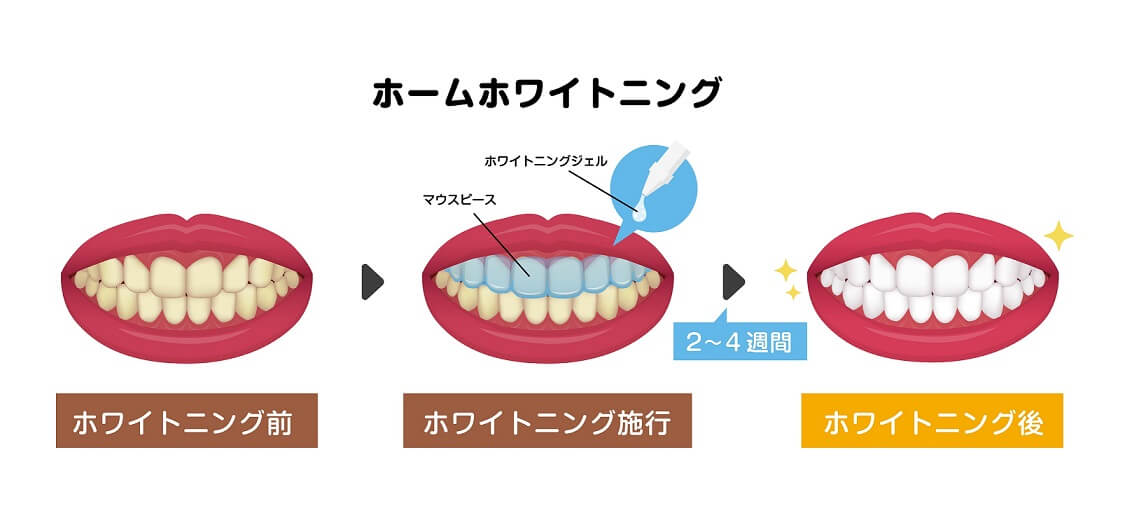 ホームホワイトニング セルフホワイトニング ホワイトニング替え