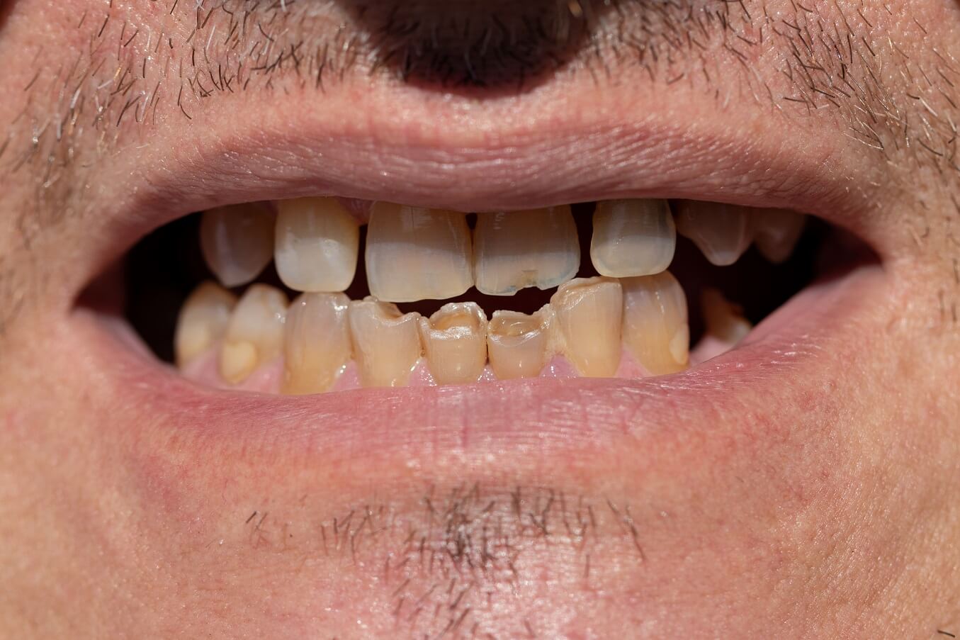歯ぎしりによる歯の先端の削れ