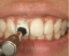 定期的な歯のクリーニング
