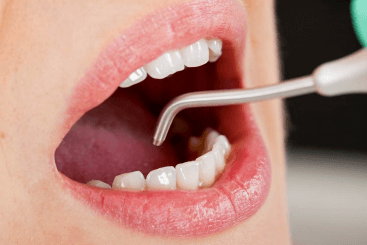 サービスクリーニング後の歯の黄ばみ