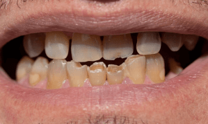 歯ぎしりなどによる歯の削れ