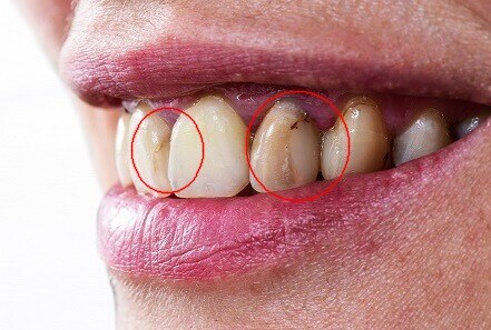 虫歯や虫歯の治療後の隙間