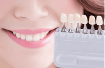 差し歯を白くする方法
