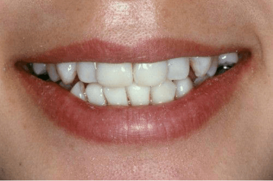 歯を真っ白にする方法