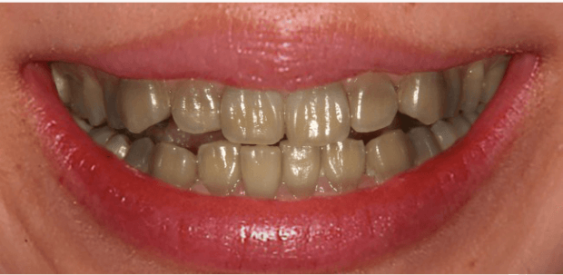 テトラサイクリン歯のホワイトニング