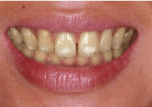 前歯の白斑を消す方法