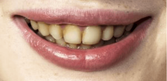 歯が黄色く変色する原因と対処法